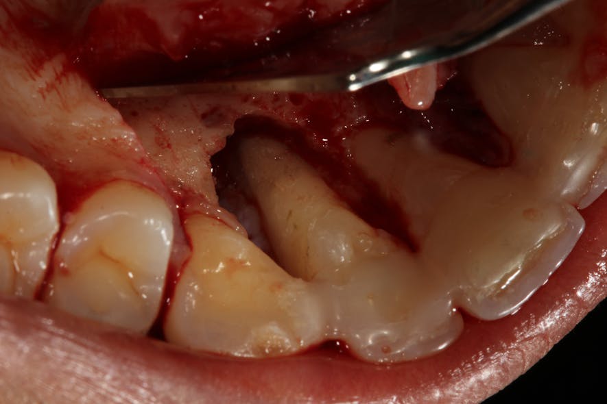 Figure 3: Clinical photo of tooth nos. 6&ndash;8 after surgical debridement and showing a large bony defect