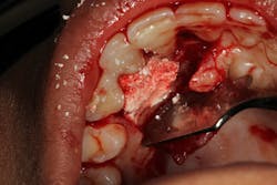 Figure 4: Bio-Oss Collagen bone graft placed to regenerate tooth nos. 6–8 Figure 4: Bio-Oss Collagen bone graft placed to regenerate tooth nos. 6–8