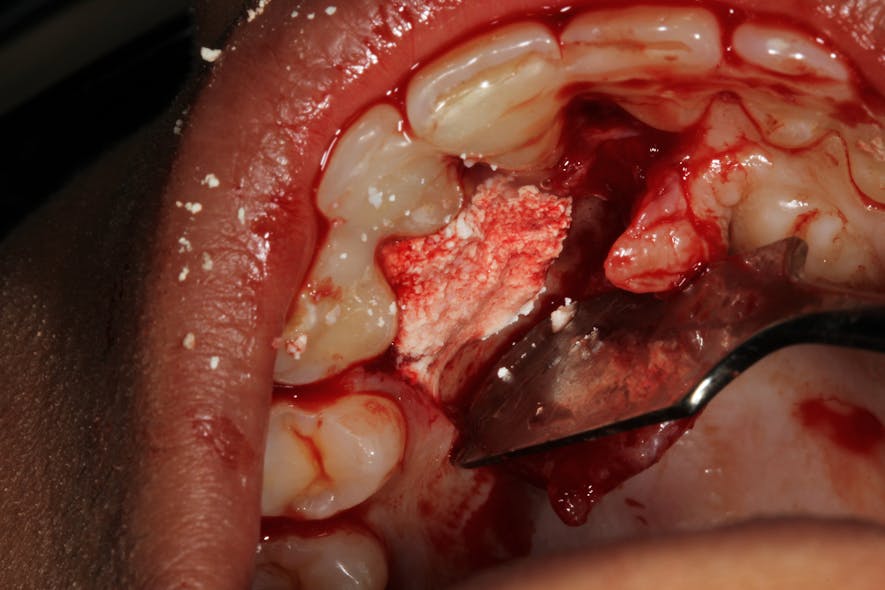 Figure 4: Bio-Oss Collagen bone graft placed to regenerate tooth nos. 6&ndash;8