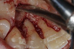 Figure 5: Surgical re-entry of the area one year later showing bone repair Figure 5: Surgical re-entry of the area one year later showing bone repair