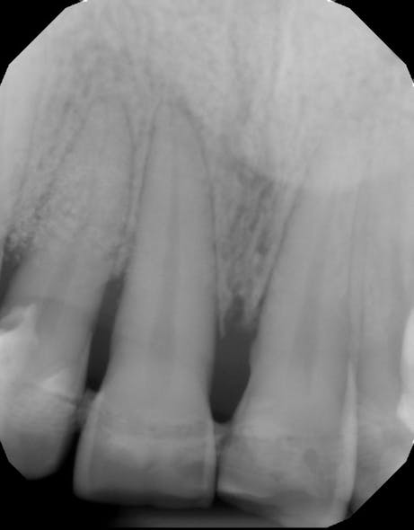 Figure 6: Radiograph two years after surgery showing complete bone fill in teeth that were planned for extraction