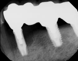 Figure 7: Radiograph of multiple implant-supported bridges affected by severe peri-implantitis seven years after placement Figure 7: Radiograph of multiple implant-supported bridges affected by severe peri-implantitis seven years after placement