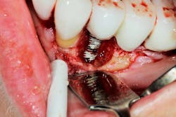 Figure 8: Clinical photo after surgical debridement of implant with severe bone loss Figure 8: Clinical photo after surgical debridement of implant with severe bone loss