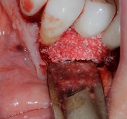 Figure 9: Clinical photo of implant grafted with Bio-Oss Collagen to attempt to save the implant bridge