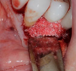Figure 9: Clinical photo of implant grafted with Bio-Oss Collagen to attempt to save the implant bridge Figure 9: Clinical photo of implant grafted with Bio-Oss Collagen to attempt to save the implant bridge