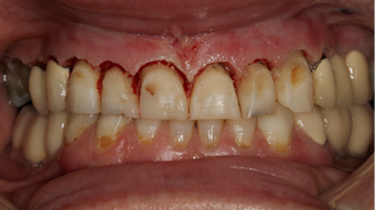 Covid 19 And The Problem With Dental Aerosols Perio Implant Advisory