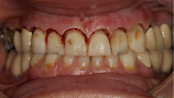 Covid 19 And The Problem With Dental Aerosols Perio Implant Advisory Covid 19 And The Problem With Dental Aerosols Perio Implant Advisory