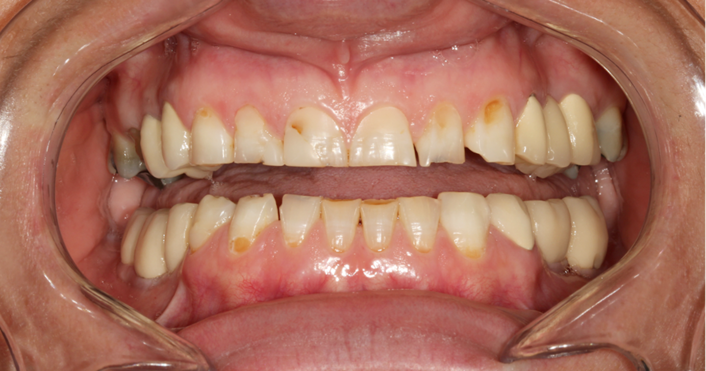 Sjögren's syndrome: Considerations during and after cosmetic dentistry ...