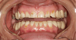 Figure 1: Patient presented with smooth-surface caries and worn incisal edges Figure 1: Patient presented with smooth-surface caries and worn incisal edges