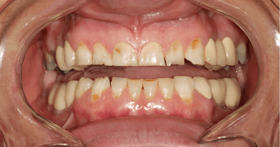 Figure 1: Patient presented with smooth-surface caries and worn incisal edges