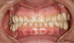 Figure 2: Patient presented with smooth-surface caries and worn incisal edges