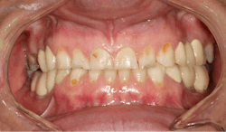 Figure 2: Patient presented with smooth-surface caries and worn incisal edges Figure 2: Patient presented with smooth-surface caries and worn incisal edges