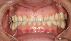 Figure 2: Patient presented with smooth-surface caries and worn incisal edges Figure 2: Patient presented with smooth-surface caries and worn incisal edges