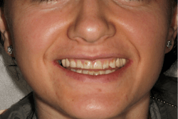 Figure 3: Patient presented with worn incisal edges and occlusal surfaces, resulting in lost vertical dimension. Note the presence of bilateral angular cheilitis. Figure 3: Patient presented with worn incisal edges and occlusal surfaces, resulting in lost vertical dimension. Note the presence of bilateral angular cheilitis.