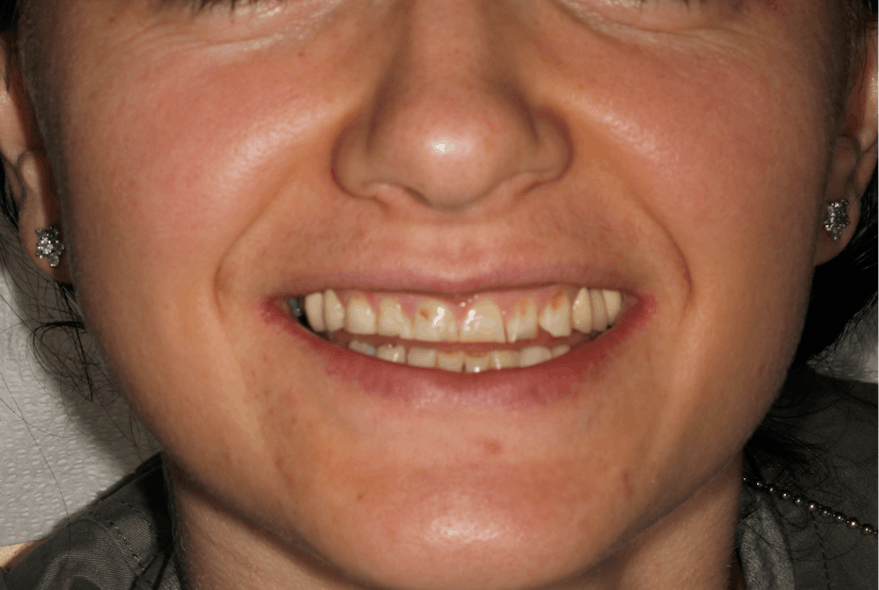 Figure 3: Patient presented with worn incisal edges and occlusal surfaces, resulting in lost vertical dimension. Note the presence of bilateral angular cheilitis.