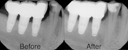 Figure 4: Patient presented with high caries rate. Images show before and after caries control.