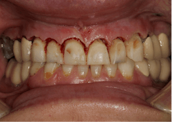 Figure 5: Solea laser was used for soft- and hard-tissue crown lengthening and frenectomy.