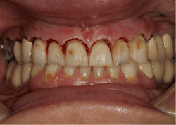 Figure 5: Solea laser was used for soft- and hard-tissue crown lengthening and frenectomy. Figure 5: Solea laser was used for soft- and hard-tissue crown lengthening and frenectomy.