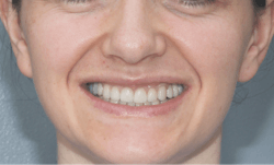 Figure 6: Full-mouth rehabilitation with resolution of bilateral angular cheilitis Figure 6: Full-mouth rehabilitation with resolution of bilateral angular cheilitis