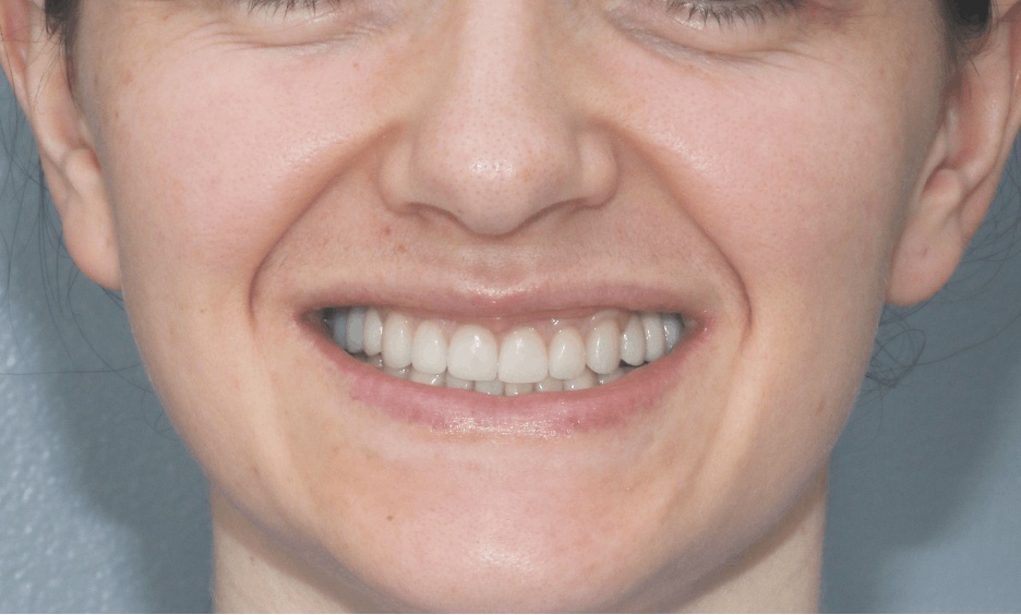 Figure 6: Full-mouth rehabilitation with resolution of bilateral angular cheilitis