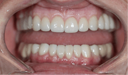 Figure 7: Full-mouth rehabilitation included full- and three-quarter coverage e.max crowns with zirconia bridges Figure 7: Full-mouth rehabilitation included full- and three-quarter coverage e.max crowns with zirconia bridges