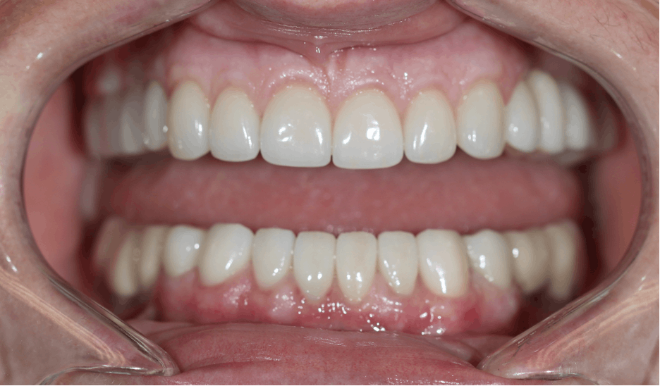Figure 7: Full-mouth rehabilitation included full- and three-quarter coverage e.max crowns with zirconia bridges