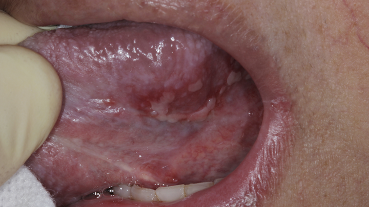 Top 5 oral manifestations of COVID-19 | Perio-Implant Advisory