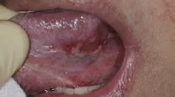 Figure 1: COVID-19–positive patient with ulceration on tongue. This patient had many ulcerations in the mouth that healed after disease resolution.