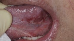Figure 1: COVID-19&ndash;positive patient with ulceration on tongue. This patient had many ulcerations in the mouth that healed after disease resolution.
