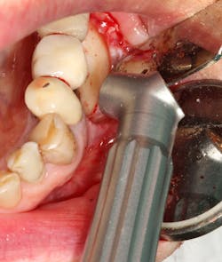 Figure 1: A 9.3 micron CO2 laser is used to detoxify the dental implant fixtures and inner soft-tissue flap lining. Figure 1: A 9.3 micron CO2 laser is used to detoxify the dental implant fixtures and inner soft-tissue flap lining.