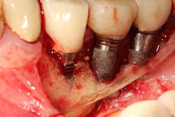 Figure 2: Completely detoxified dental implant and soft-tissue flap prior to tissue grafting Figure 2: Completely detoxified dental implant and soft-tissue flap prior to tissue grafting