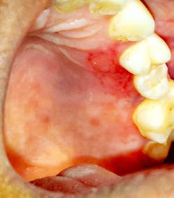Figure 1: Hard palate showing erosive lesion in a COVID-19–positive female Figure 1: Hard palate showing erosive lesion in a COVID-19–positive female