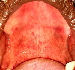 Figure 2: Generalized erythema, petechiae, and erosive lesions in a COVID-19–positive male Figure 2: Generalized erythema, petechiae, and erosive lesions in a COVID-19–positive male