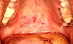Figure 3: Petechial spots on the hard palate of a COVID-19–positive patient Figure 3: Petechial spots on the hard palate of a COVID-19–positive patient