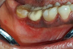 Figure 4: Erosive lesion on mandibular posterior gingival area Figure 4: Erosive lesion on mandibular posterior gingival area