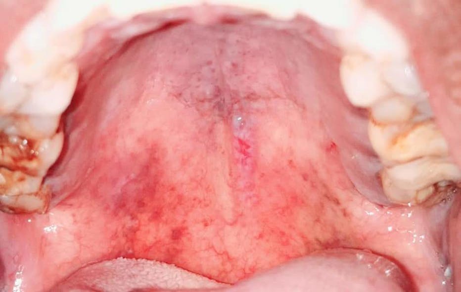 Figure 5: Diffuse reddish lesions on the hard palate of a 52-year-old COVID-19&ndash;positive patient