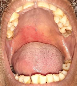 Figure 6: Reddish lesion on the right side of the hard and soft palate that crosses the midline in a COVID-19–positive patient Figure 6: Reddish lesion on the right side of the hard and soft palate that crosses the midline in a COVID-19–positive patient
