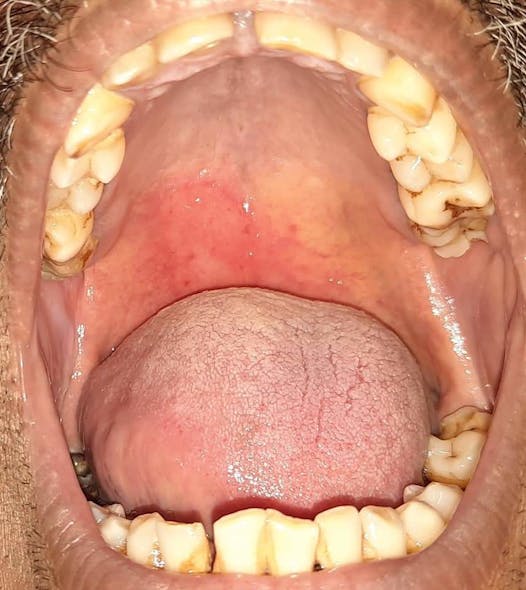 Figure 6: Reddish lesion on the right side of the hard and soft palate that crosses the midline in a COVID-19&ndash;positive patient