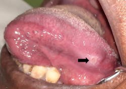 Figure 7: Large ulcer on the left lateral aspect of the tongue in an active COVID-19–positive patient Figure 7: Large ulcer on the left lateral aspect of the tongue in an active COVID-19–positive patient