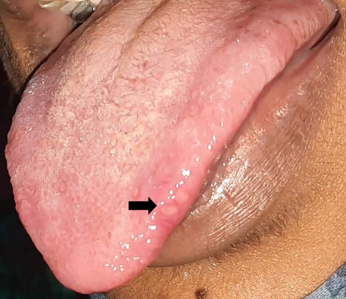 Figure 8: Ulcers and petechiae spots on multiple areas of the oral cavity