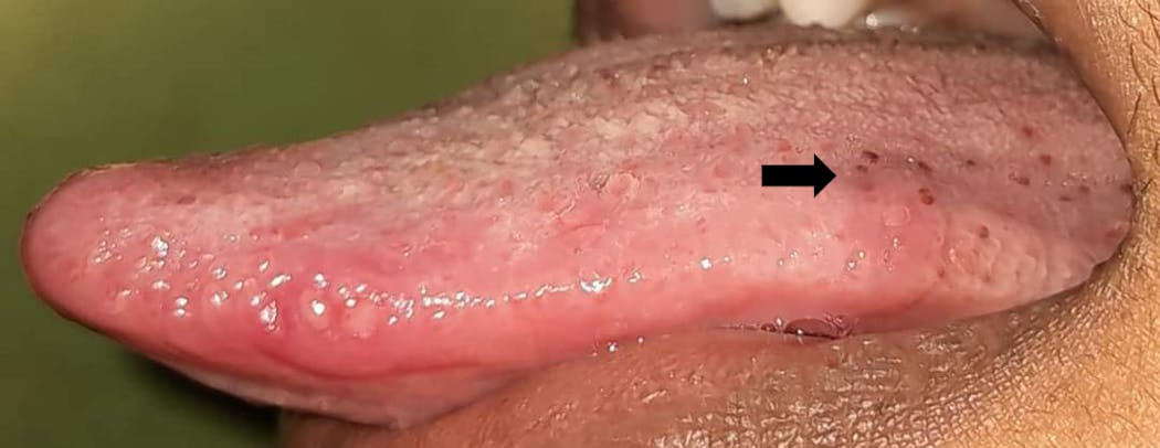 Figure 9: Ulcers and petechiae spots on multiple areas of the oral cavity