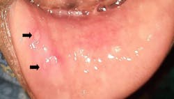 Figure 10: Ulcers and petechiae spots on multiple areas of the oral cavity
