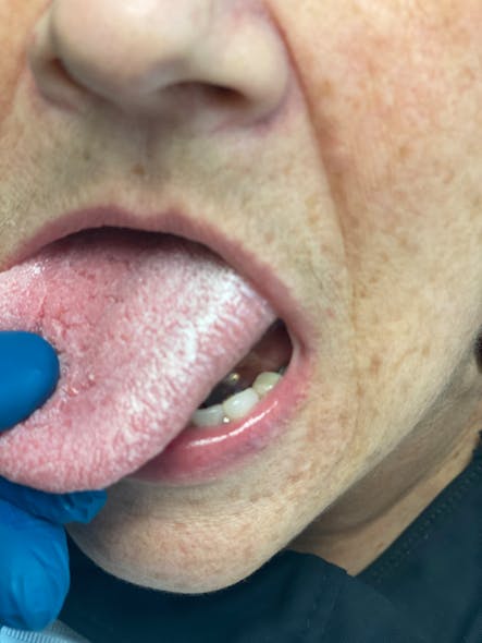 Figure 2: White film that coats the tongue in a diagnosed COVID-19&ndash;positive patient