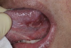 Figure 3: Lesion extending from the lateral border to the ventral tongue on a patient recently diagnosed with COVID-19