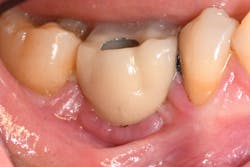 Figure 1a: Mandibular right first molar implant had its crown inserted more than five years ago. The screw retaining this crown is loose, and the tissue is inflamed from this adverse event.