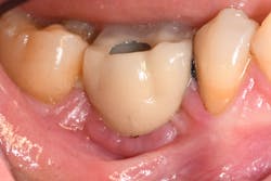 Figure 1a: Mandibular right first molar implant had its crown inserted more than five years ago. The screw retaining this crown is loose, and the tissue is inflamed from this adverse event. Figure 1a: Mandibular right first molar implant had its crown inserted more than five years ago. The screw retaining this crown is loose, and the tissue is inflamed from this adverse event.