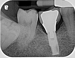 Figure 1b: Radiograph displaying the loose crown on the mandibular right first molar. Note that bone levels remain stable.
