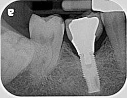 Figure 1b: Radiograph displaying the loose crown on the mandibular right first molar. Note that bone levels remain stable. Figure 1b: Radiograph displaying the loose crown on the mandibular right first molar. Note that bone levels remain stable.