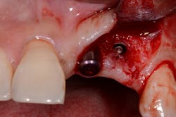 Figure 2b: A fractured screw being retrieved from inside the dental implant. The soft tissue had overgrown the site. Figure 2b: A fractured screw being retrieved from inside the dental implant. The soft tissue had overgrown the site.
