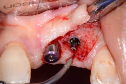 Figure 2c: The broken screw being retrieved. It required the use of an ultrasonic instrument. Figure 2c: The broken screw being retrieved. It required the use of an ultrasonic instrument.